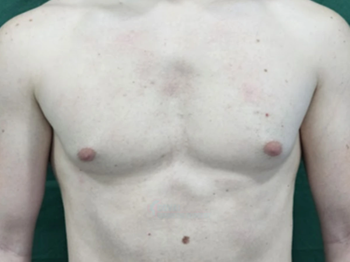 Before - Puffy Nipple